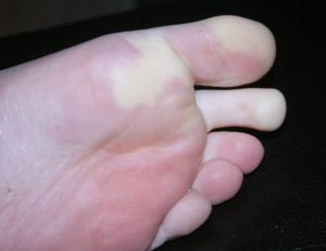 Онемение пальцев на ногах
