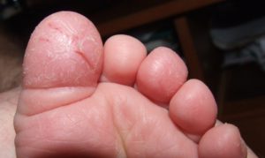 Шелушение кожи и трещины на большом пальце