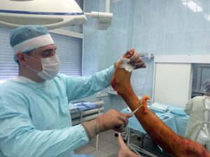 Операция при переломе лодыжки