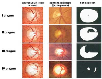Глазные заболевания - атрофия нерва
