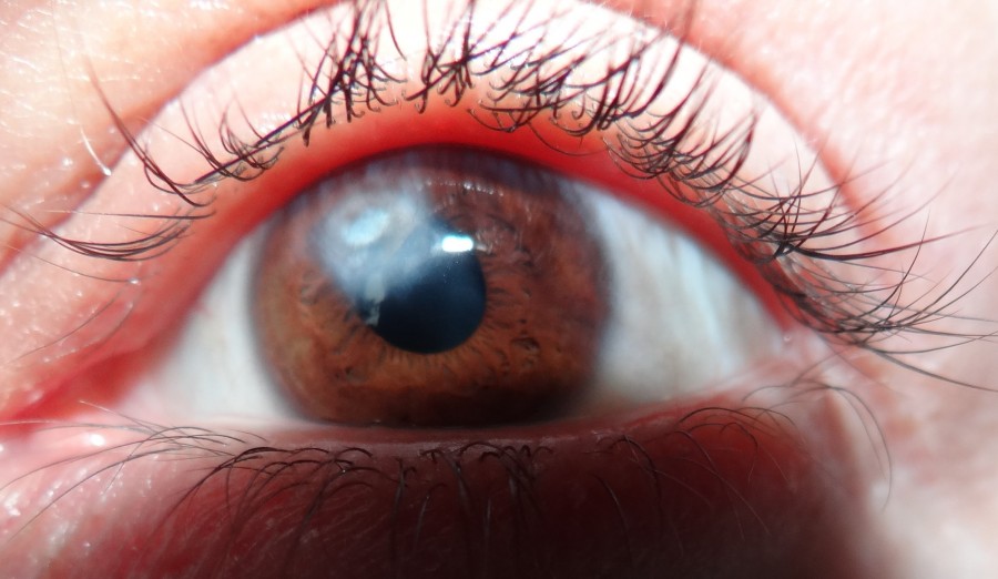 Заболевание глаз - бельмо