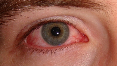 Заболевание глаз - эписклерит