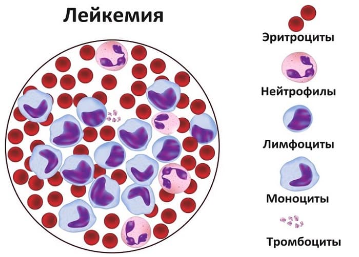 Клетки крови при лейкемии