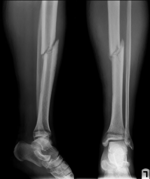 Перелом кости на рентгене