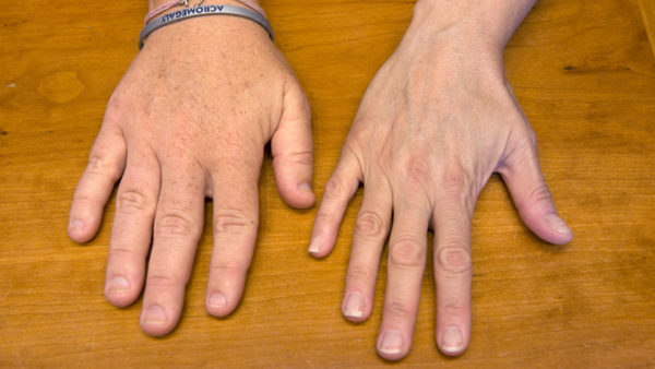 Пример акромегалии на руке человека с больным гипофизом