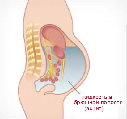 Схема развития асцита в брюшной полости