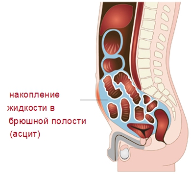 Развитие асцита