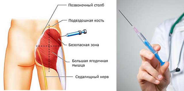 Место для укола в ягодицу