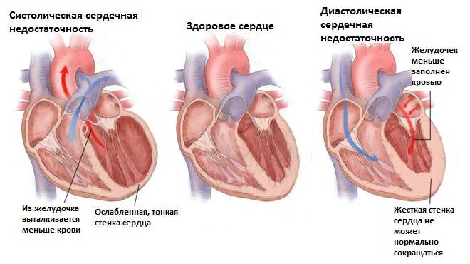 Сердечная недостаточность