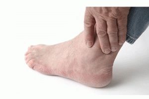 Остеоартроз ног
