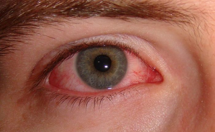 глазной дирофиляриоз