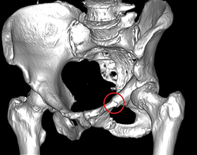 Возможные последствия перелома лобковой кости таза