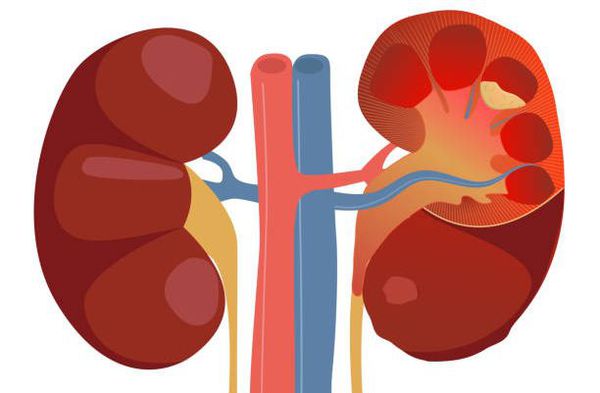 Почки при остром пиелонефрите