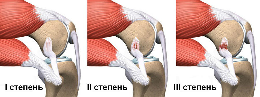 Симптомы разрыва колена