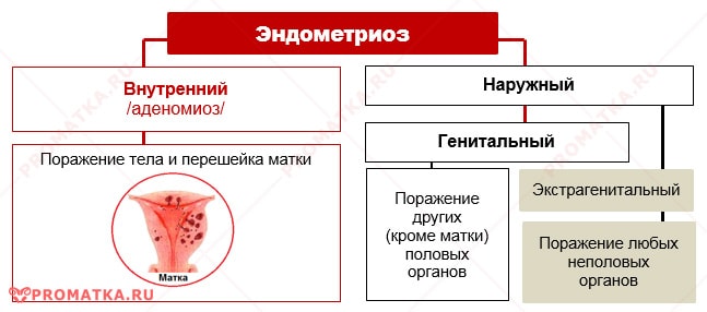 Классификация эндометриоза – схема 