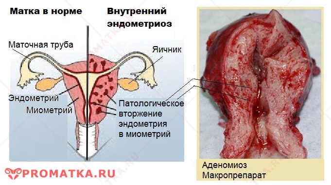 Внутренний эндометриоз - схема  