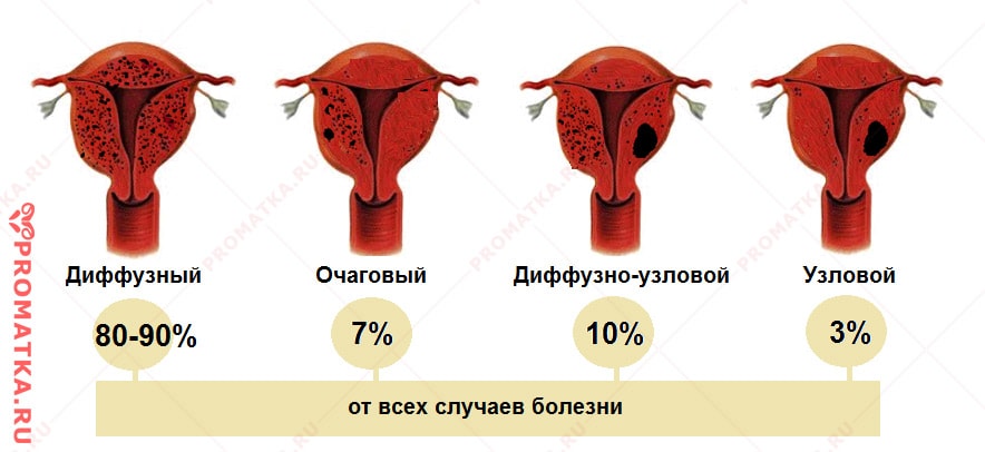 Формы внутреннего эндометриоза – схема