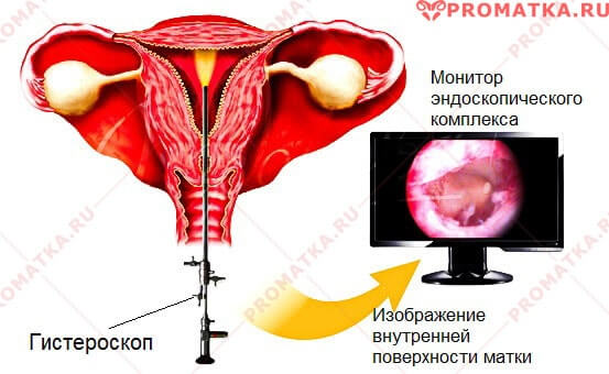 Гистероскопия эндометрия – схема 