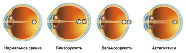 зрение при гиперметропии