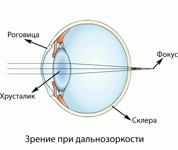 гиперметропия глаза
