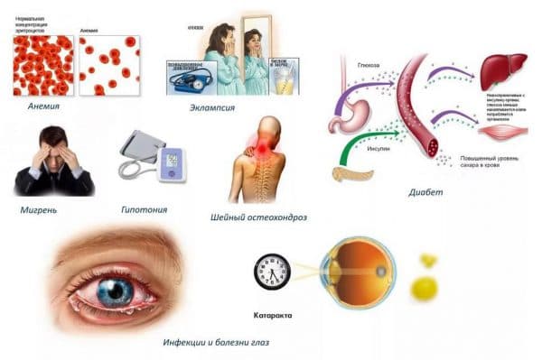 Заболевания, приводящие к появлению вспышек перед глазами