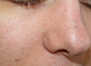 Инструкция по применению Ихтиола для лечения чёрных точек на лице