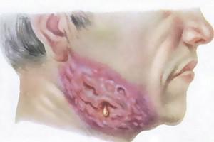 Описание актиномикоза челюстно-лицевой области с фото симптомы и способы лечения