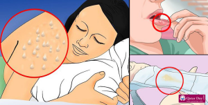 фото Ранние симптомы ВИЧ у женщин - сыпь, язвы во рту, вагиноз