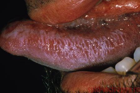Волосатая лейкоплакия у мужчины с ВИЧ - проявления СПИДа во рту.