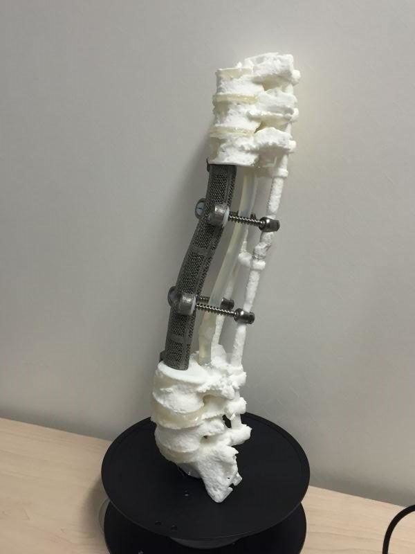 3D-печатный спинной имплантат