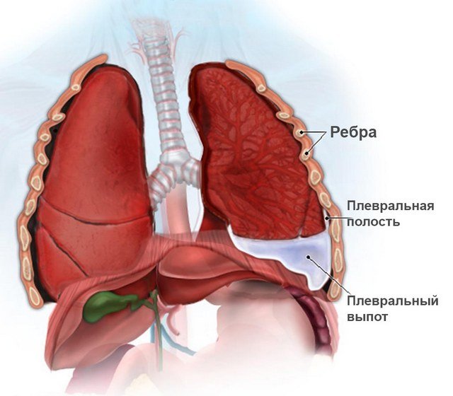 Даже такое заболевание легких, как плеврит, может стать причиной болей между лопатками