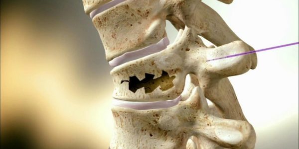 Данный вид перелома проявляется в остеопорозных костях