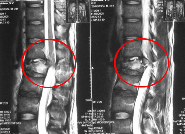 Если перелом сопровождается нарушением работы спинного мозга, то ситуация становится сложнее