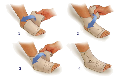 Причины, симптомы и лечение растяжения связок на ноге