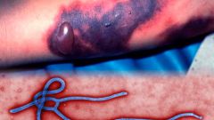 Лихорадка Эбола: описание вируса, симптомы болезни, лечение и профилактика