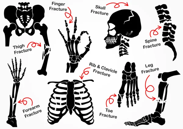 Set Bone Fracture Icon ( Pelvic , Hip , Thigh ( femur ) , Hand , Wrist , Finger , Skull , Face , Vertebra , Arm , Elbow , Thorax , Foot , Heel , Leg ) black & white design ( health care concept ) Stock Vector