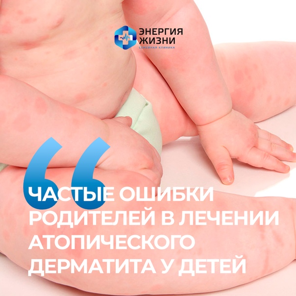 Сыпь на ступнях и ладошках у взрослого Ладонно