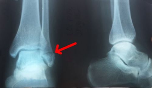Рентген-снимок перелома