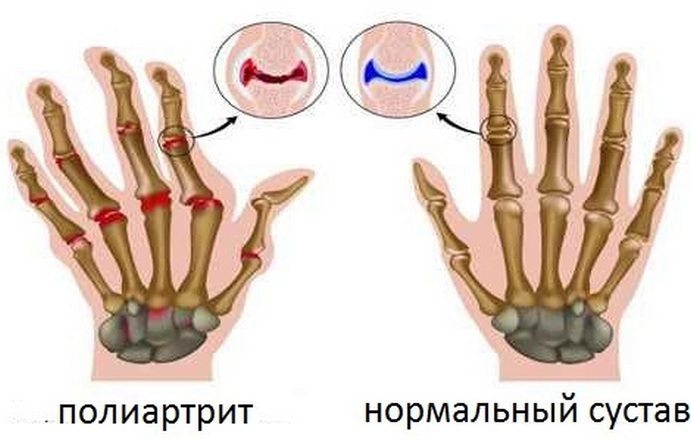 Полиартрит суставов