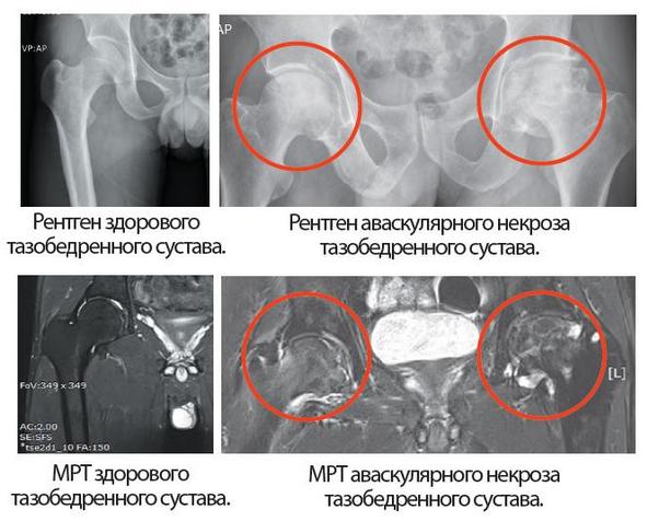 МРТ и Рентген аваскулярного некроза ТБС