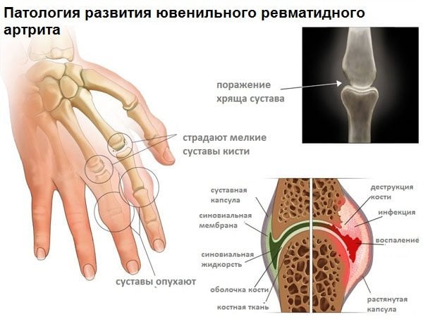 Патология развития ревматоидного артрита