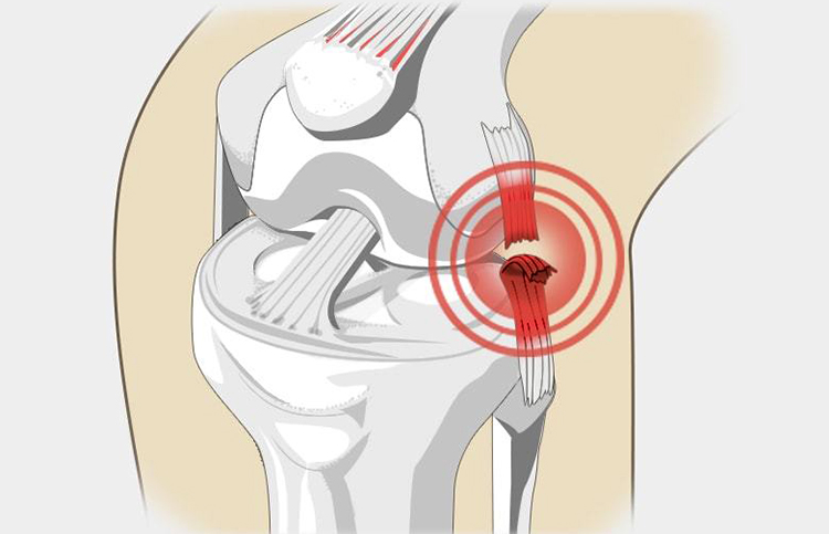 Разрыв боковых связок коленного сустава