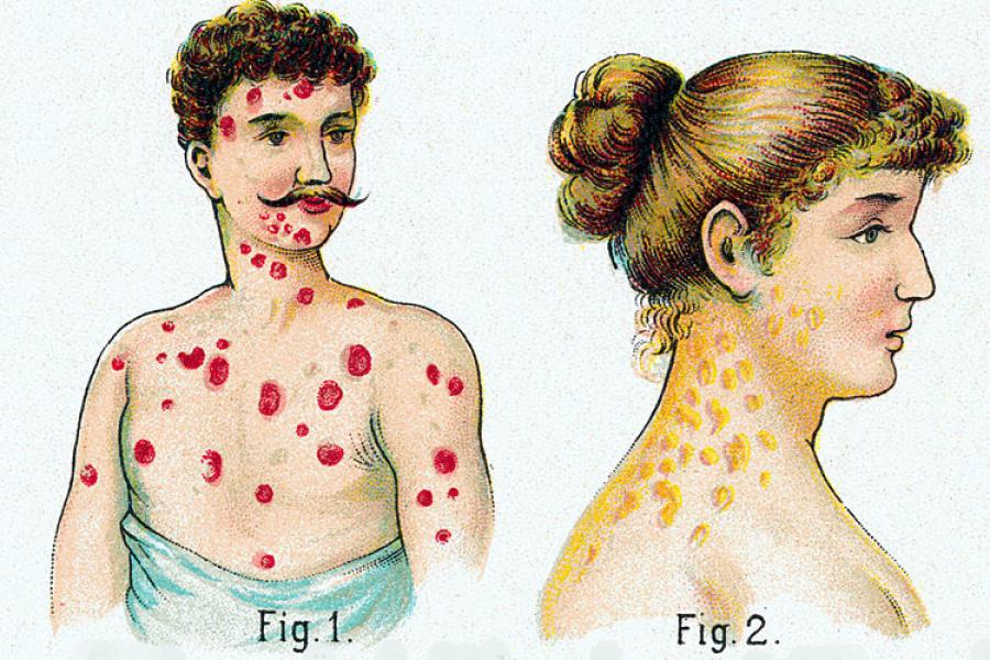 сифилис: симптомы ЗППП