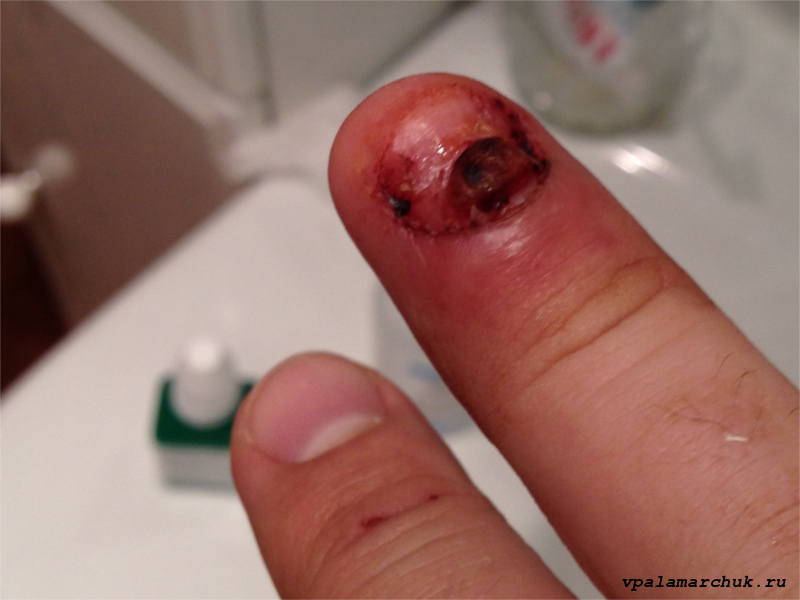 пиогенная гранулема фото палец