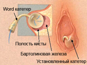 Катетер внутри бартолиновой железы