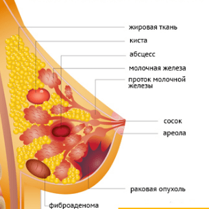 Виды образований в груди