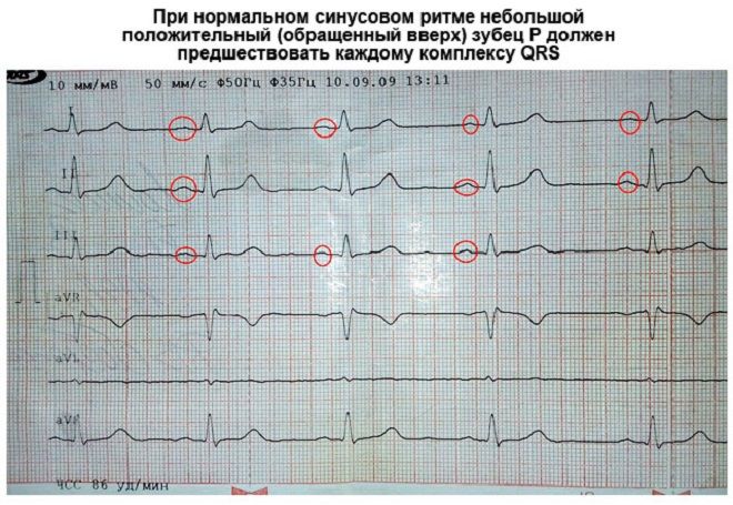 электрокардиограмма сердца