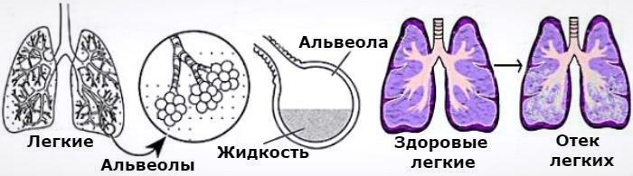 Классификация отека легких