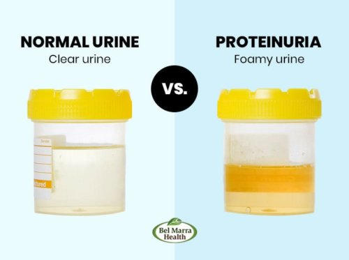 Normal urine vs Proteinuria