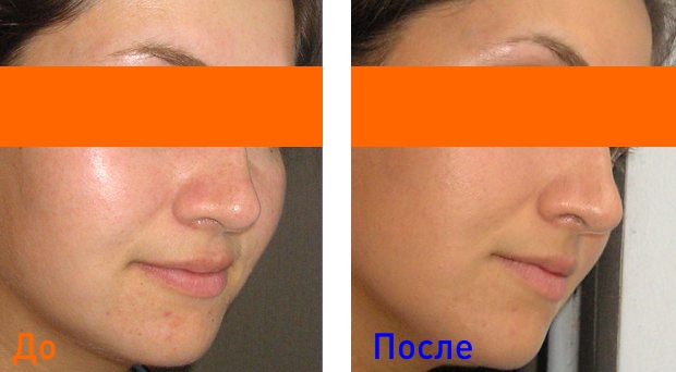 фото до и после лечения жирной кожи лица